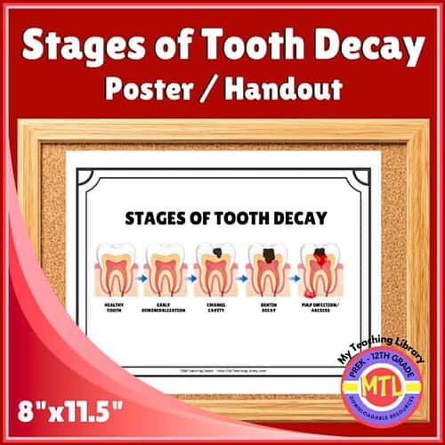 Educational poster illustrating the stages of tooth decay, from healthy tooth to pulp infection, ideal for homeschooling dental health lessons.