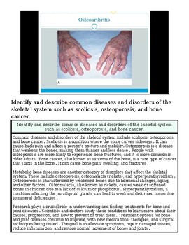 original-12626560-1.jpg Close-up of hands showing symptoms of osteoarthritis, highlighting joint inflammation and deformity.