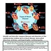 original-12639176-1.jpg Illustration of various types of heart disease including cardiomyopathy, arrhythmia, and coronary artery disease with labeled diagrams.